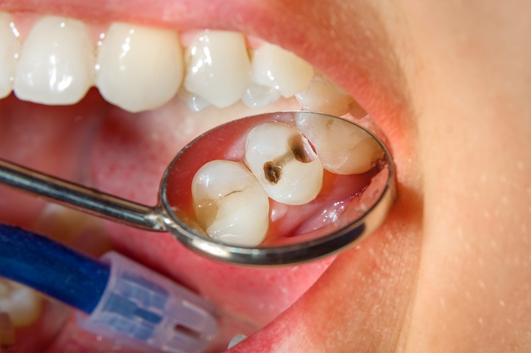serious dental diseases