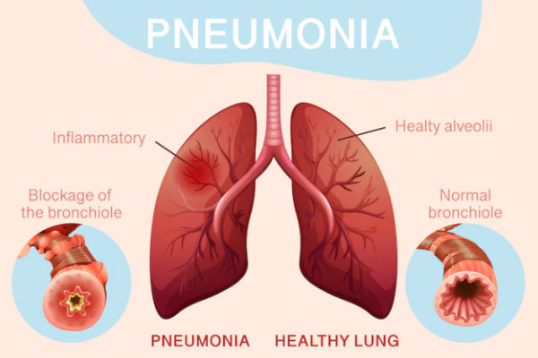 About Pneumonia