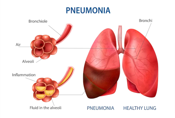 Fight Back Pneumonia With These Treatments