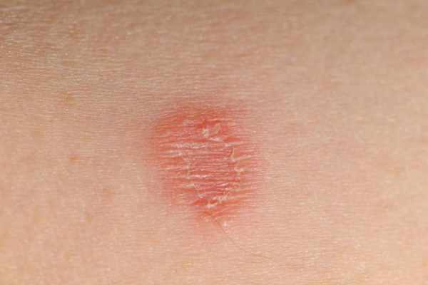 infections