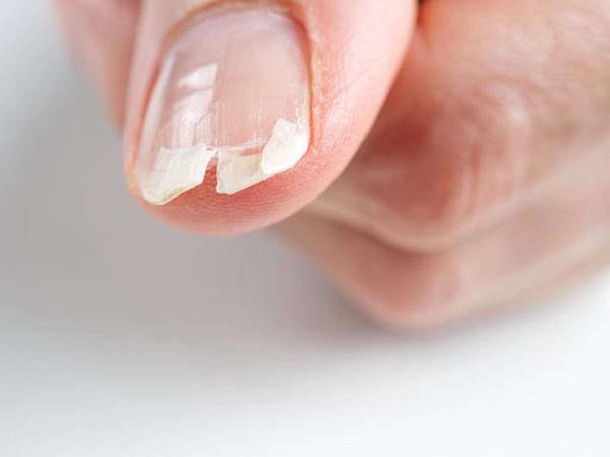 fingernail Vitamin D deficiency