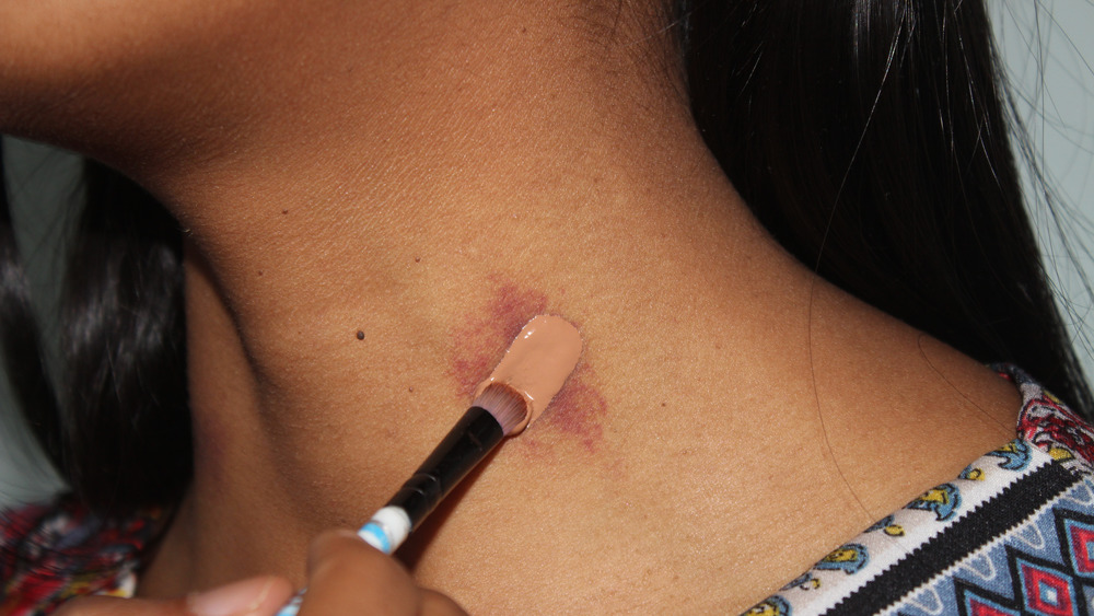 how to get rid of a hickey with concealer