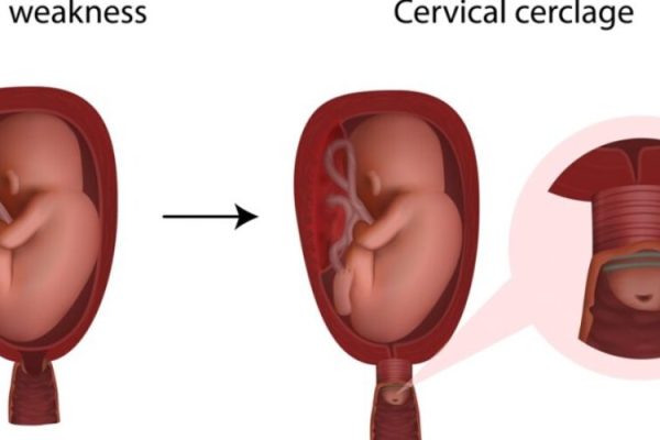 cervical cerclage