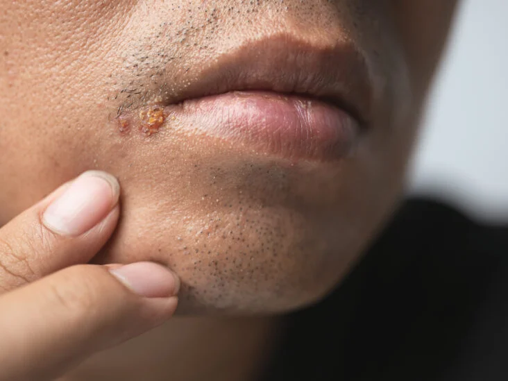 how to heal herpes sores faster 