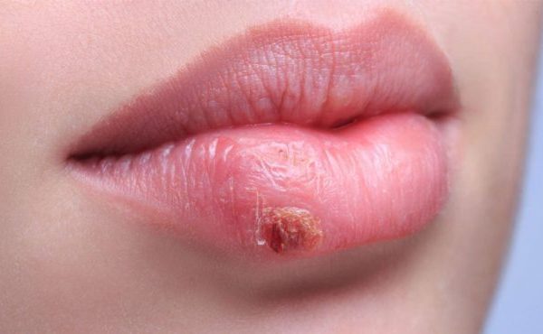how to heal herpes sores faster