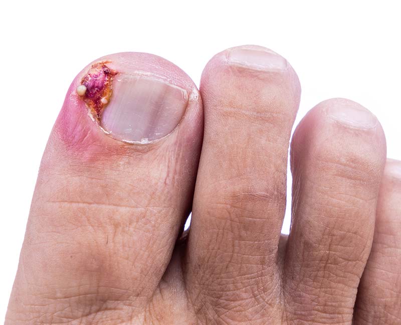 removing ingrown toenail
