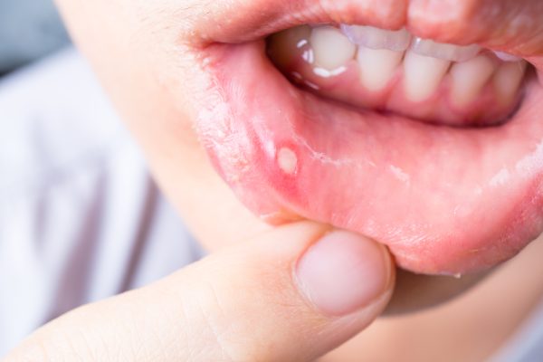 how to cure mouth ulcers