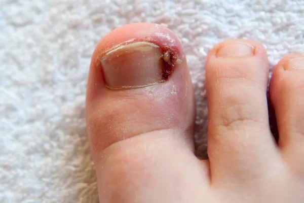 how to remove ingrown toenail