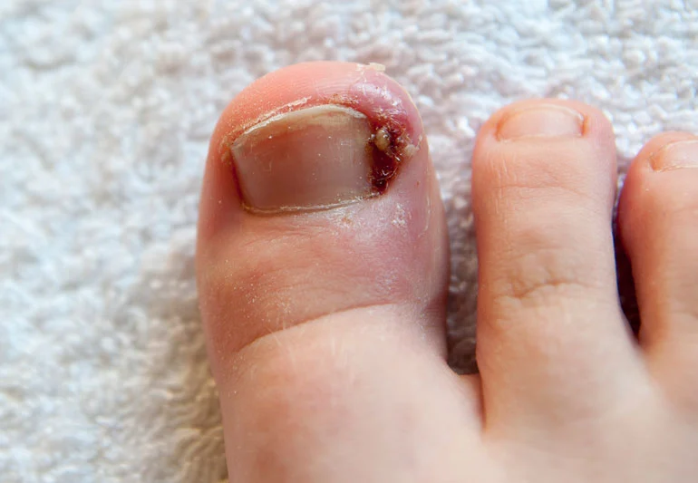 how to remove ingrown toenail