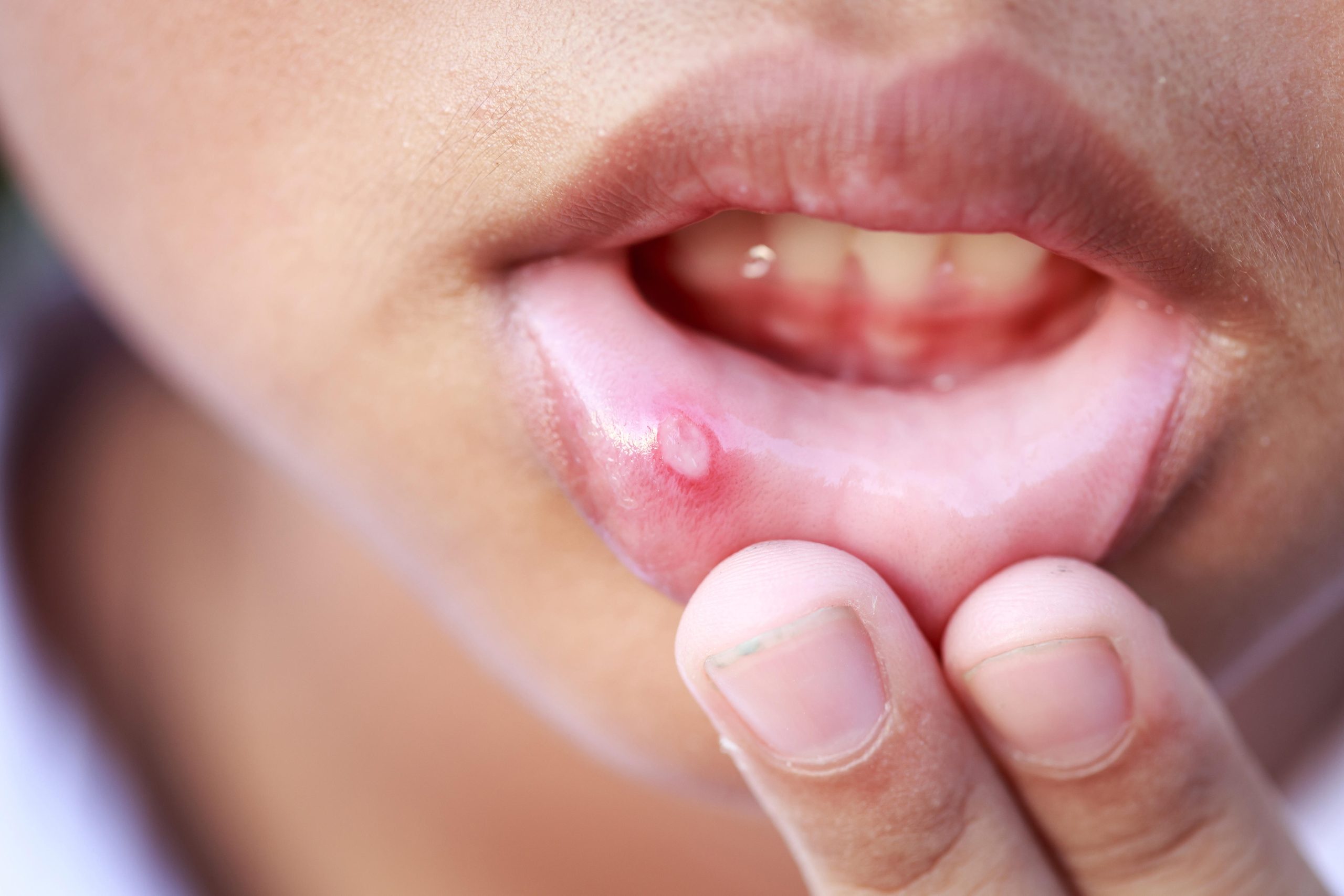 small mouth ulcers