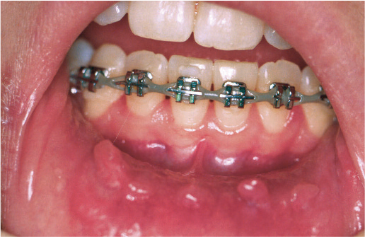 mouth-sores caused by braces