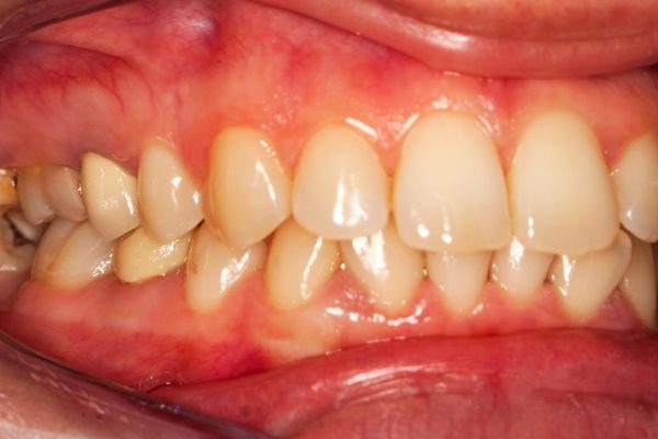 how to cure gum disease naturally