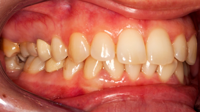 how to cure gum disease naturally