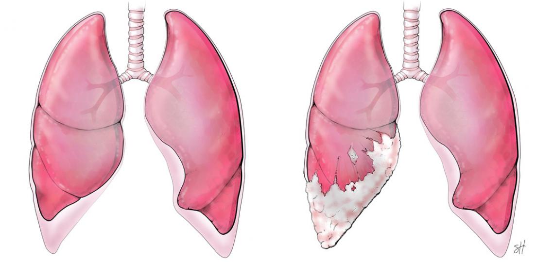 Pleural Mesothelioma