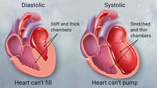 systolic and diastolic CHF