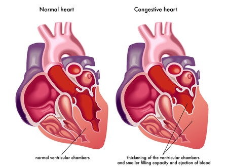 what are the 4 stages of congestive heart failure feature image