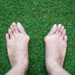 how to shrink bunions naturally