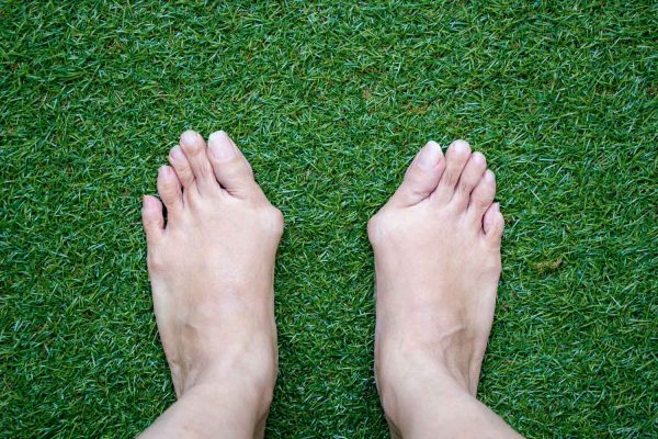 how to shrink bunions naturally