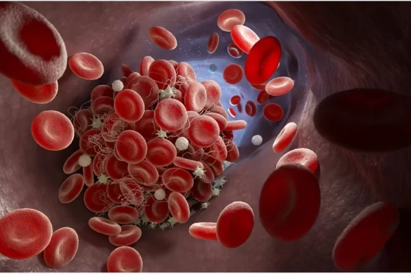 How Long Before A Pulmonary Embolism Kills You