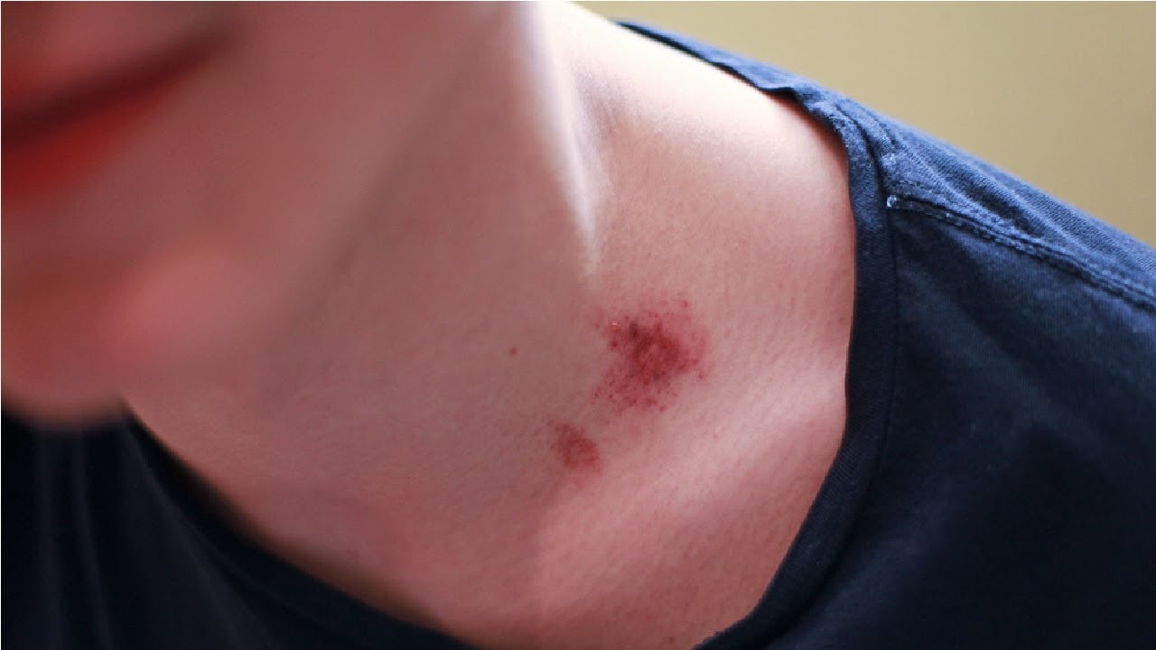 husband with hickey signs