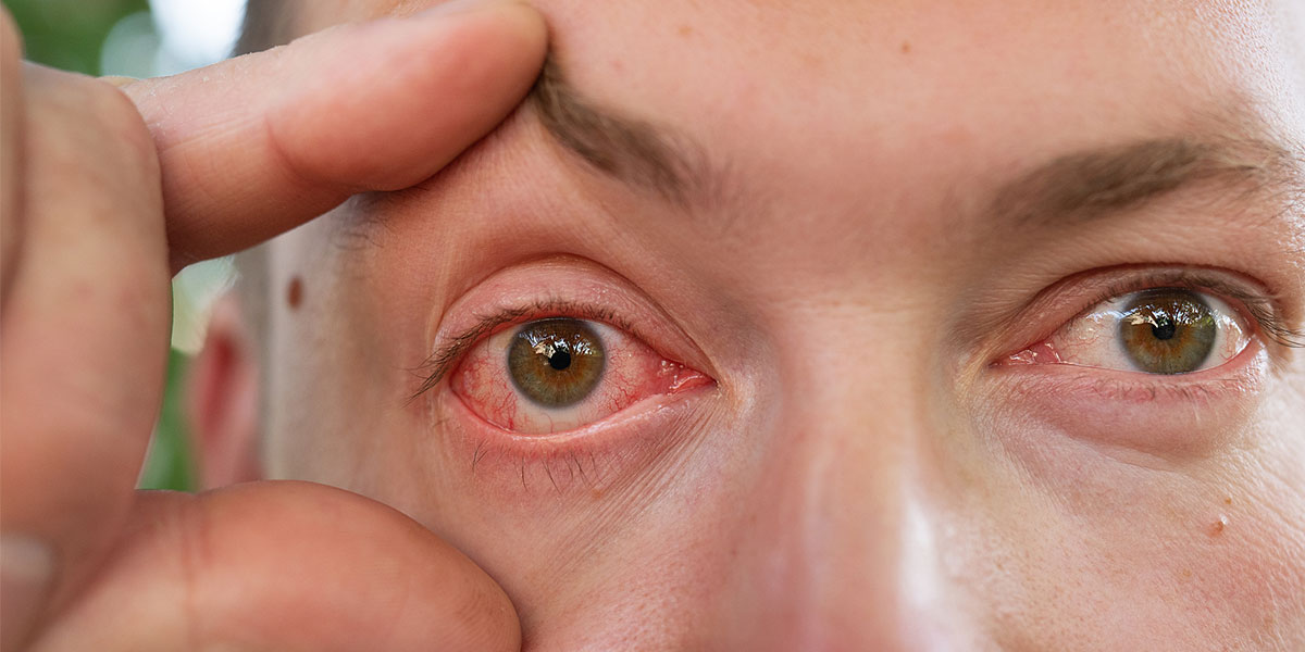 Iritis misdiagnosed as pink eye