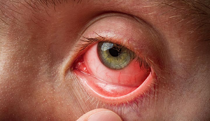 What is commonly misdiagnosed as pink eye
