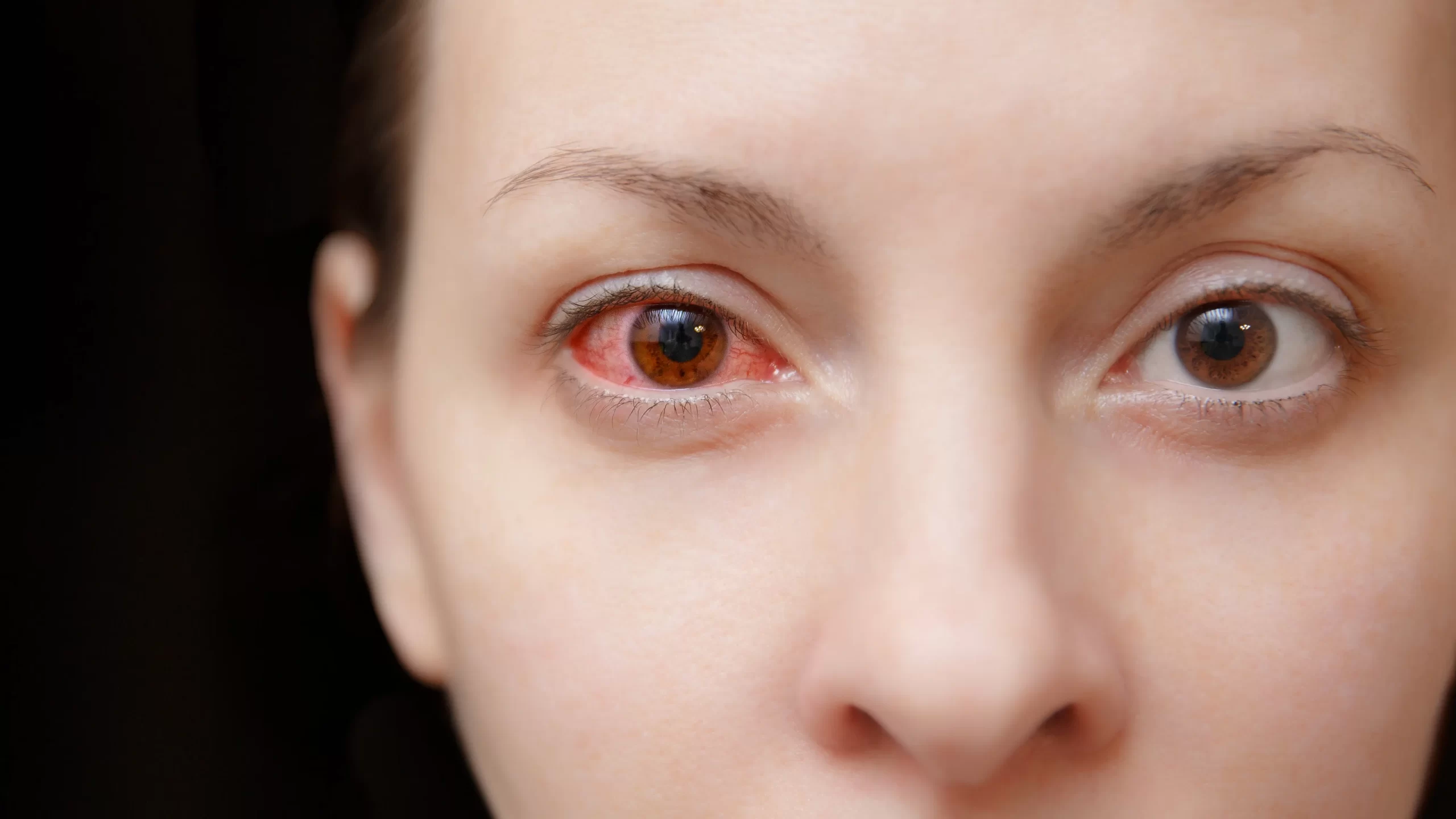 What is misdiagnosed as pink eye