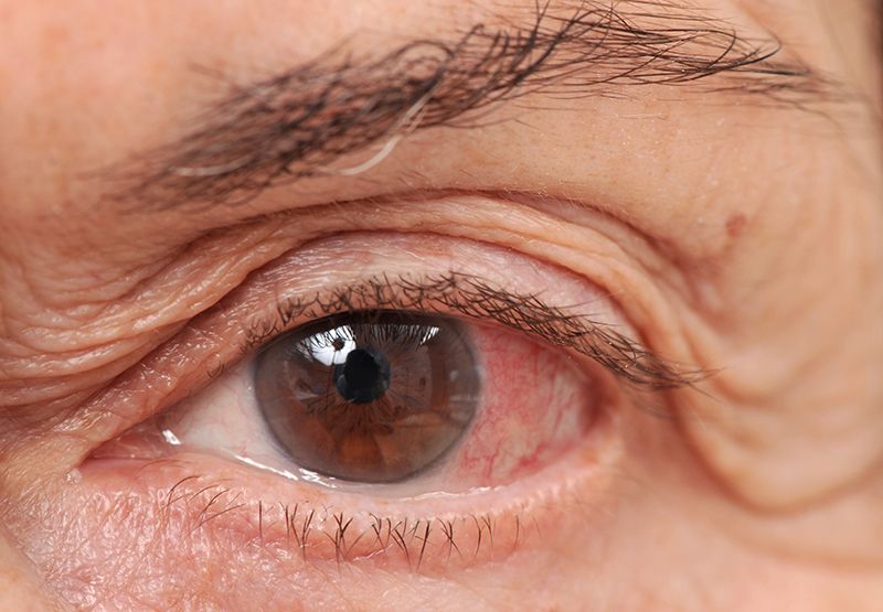 glaucoma misdiagnosed as pink eye