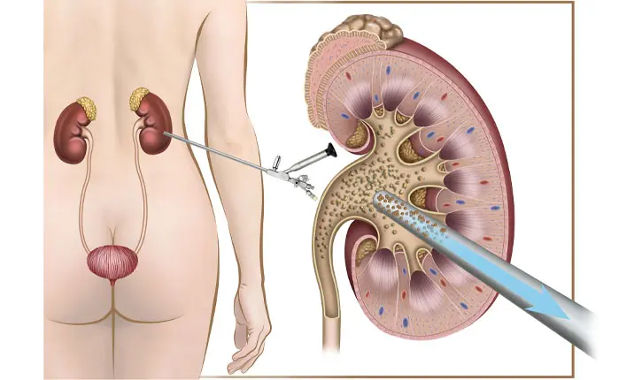 kidney stones entering ureter