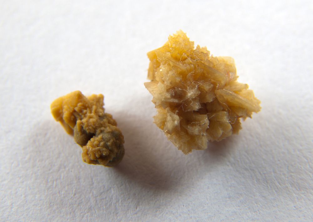 kidney stones